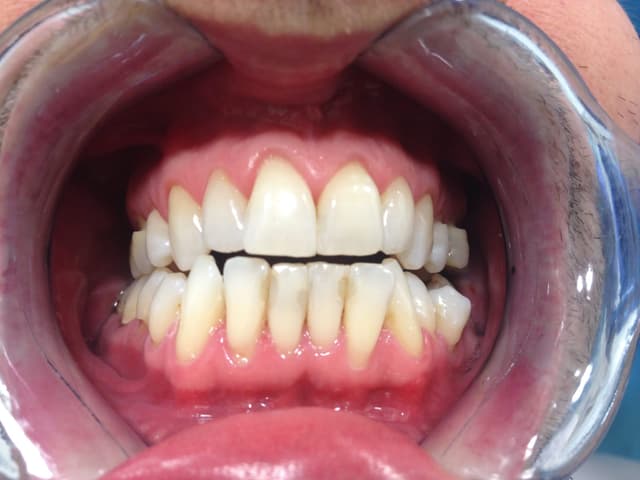 After professional whitening at our SW7 clinic