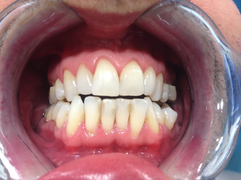 After teeth whitening - Male Teeth Whitening Patient
