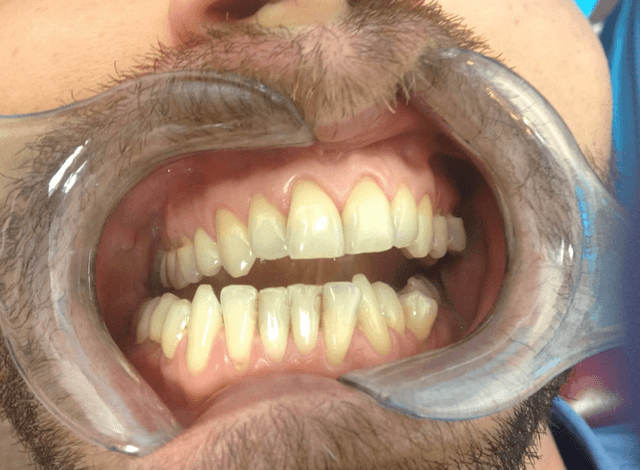 Before professional whitening at our SW7 clinic