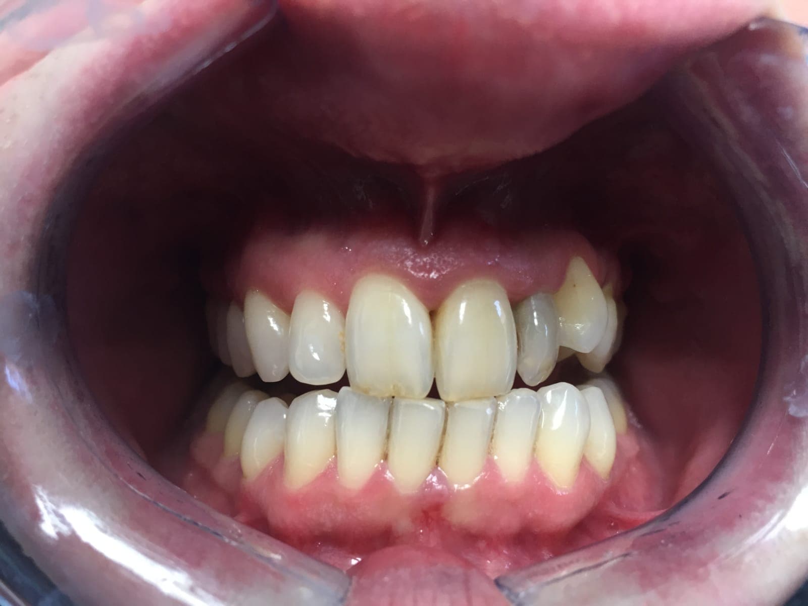 Before teeth whitening at South Kensington clinic