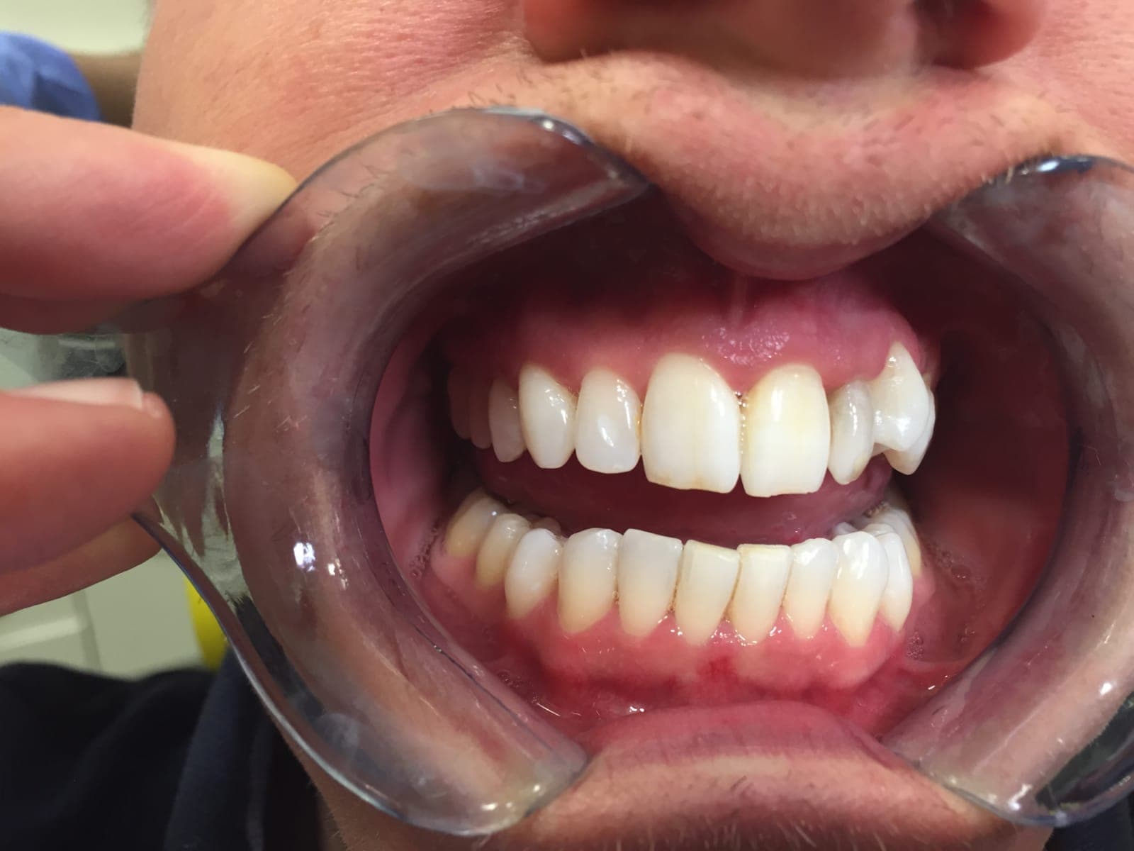 After teeth whitening treatment