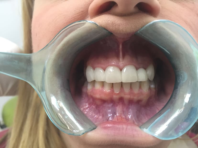 After teeth whitening - Female Whitening & Veneers Patient