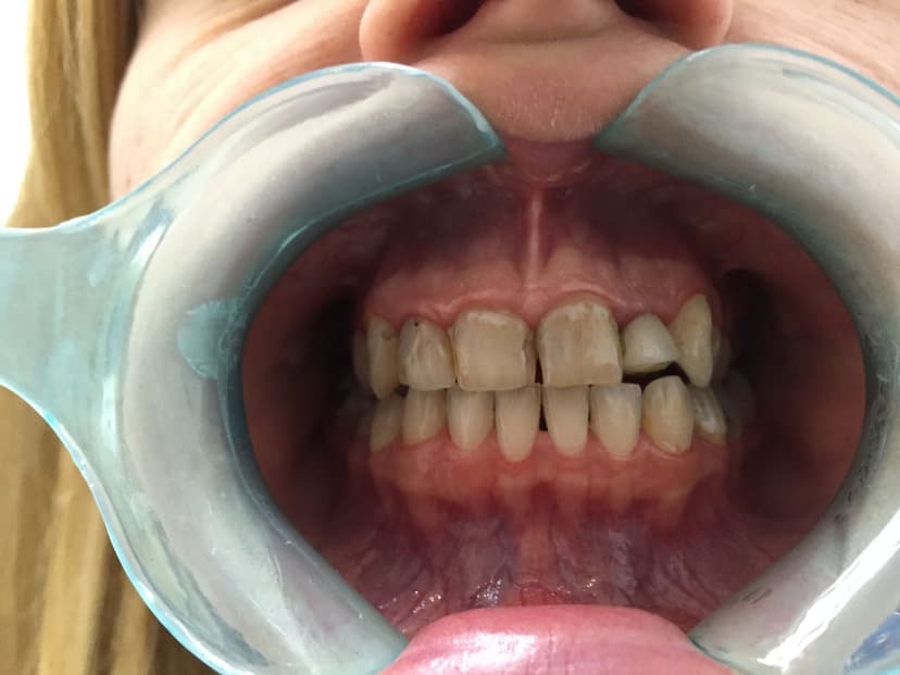 Before teeth whitening - Female Whitening & Veneers Patient