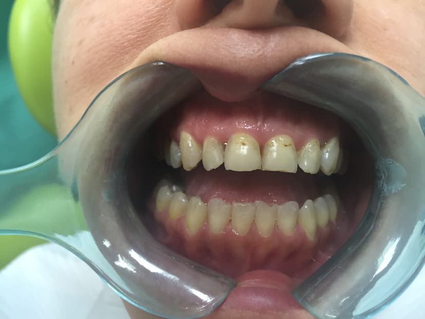 Before teeth whitening - Female Teeth Whitening Patient