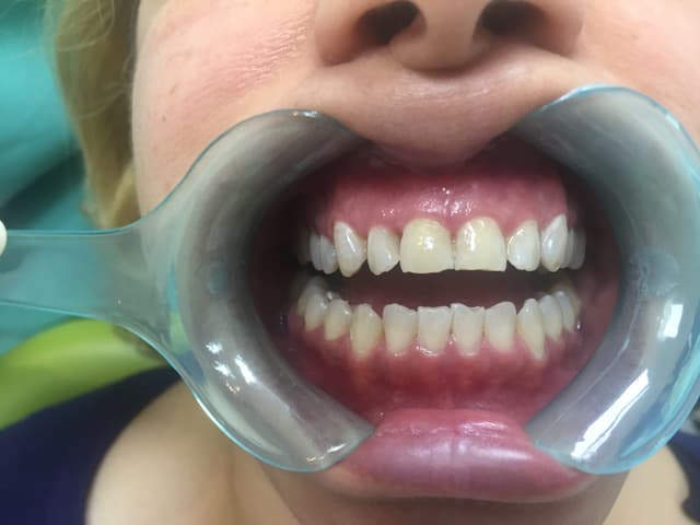 After teeth whitening - South Kensington patient