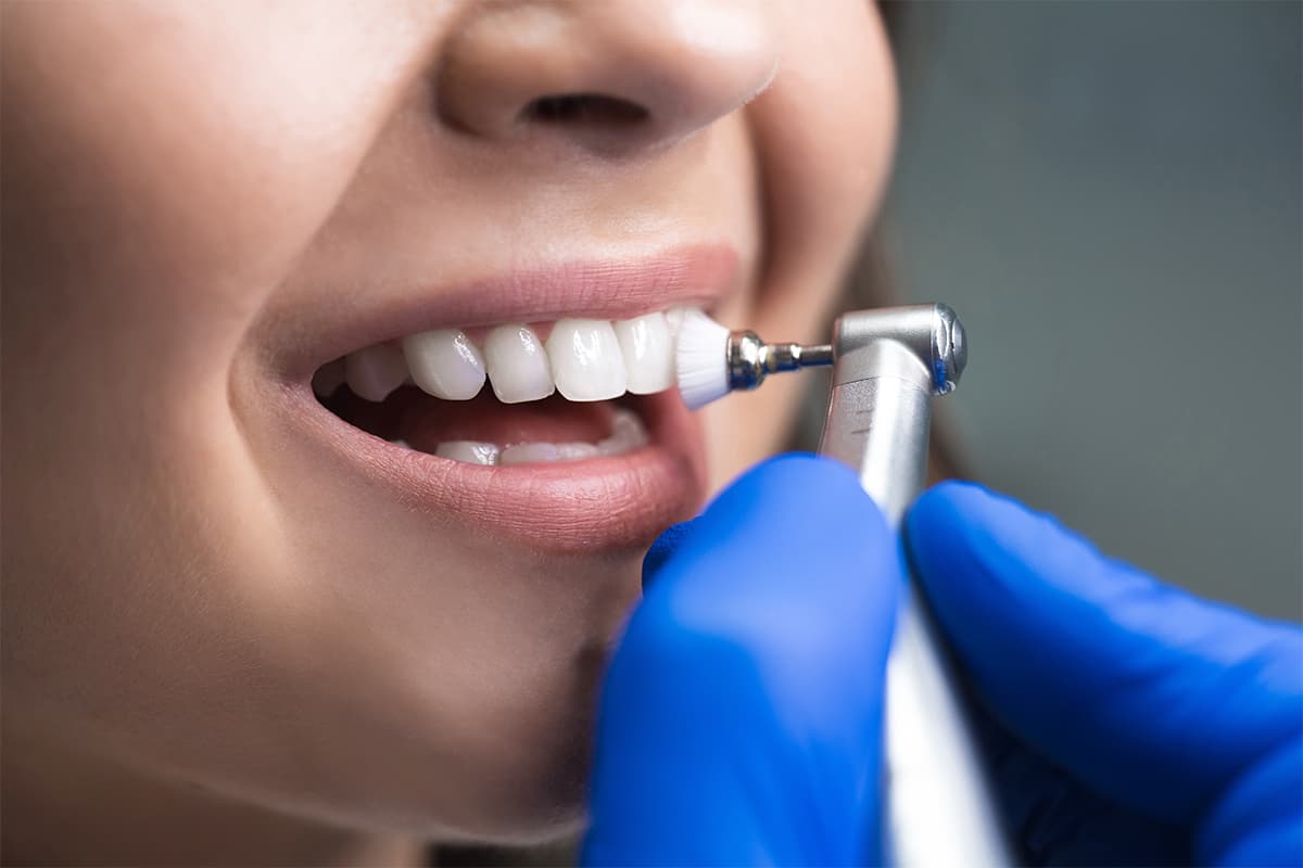 Professional Teeth Whitening Safety: Facts vs Myths