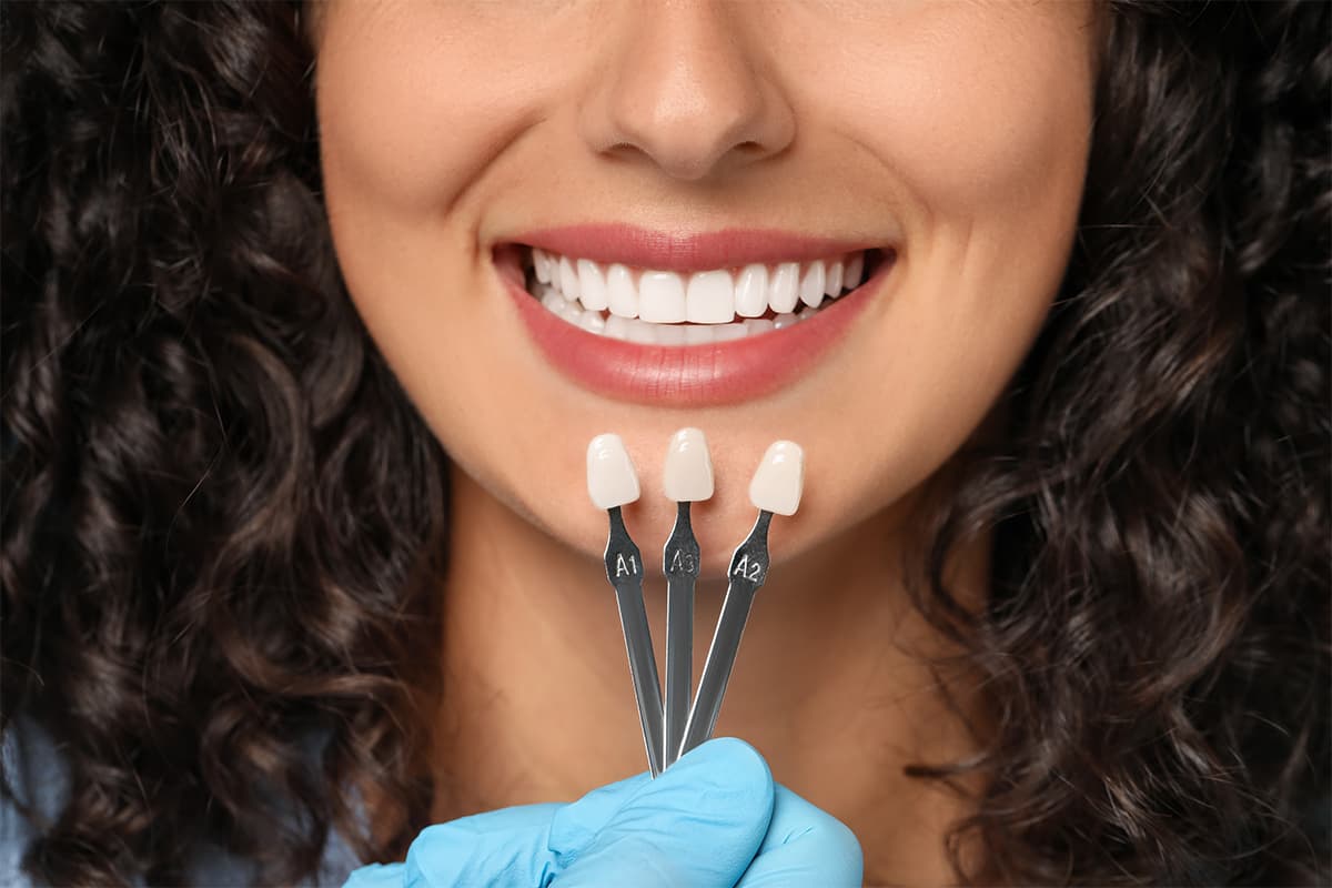 How Long Do Veneers Last? | Longevity & Care Guide