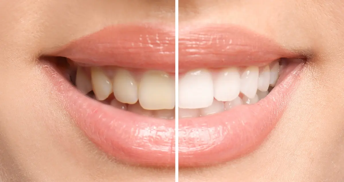 Professional Teeth Whitening vs At-Home Whitening: Why Dentist-Led Treatment in London Delivers Better Results