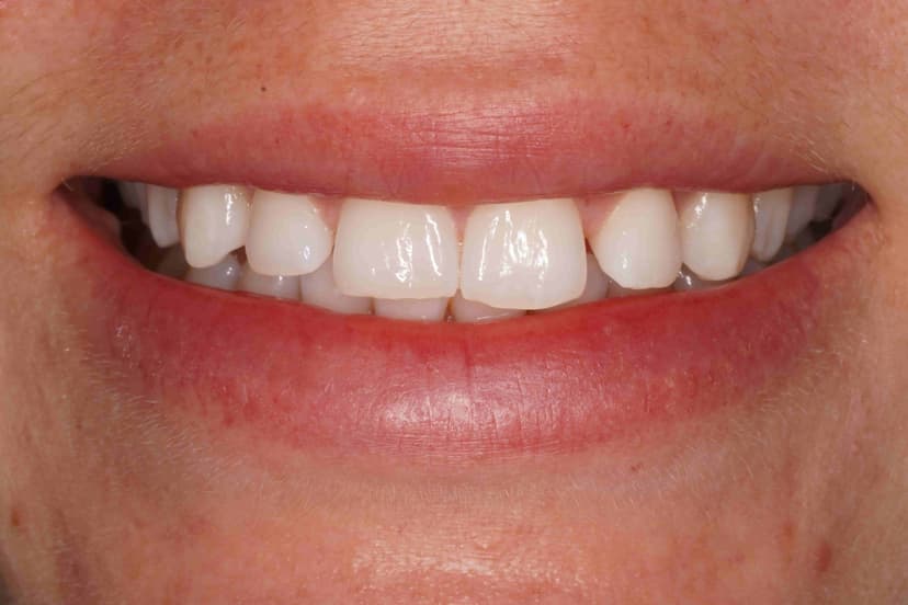 After teeth whitening - Teeth Whitening Patient