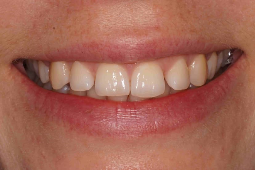 Before teeth whitening - Teeth Whitening Patient