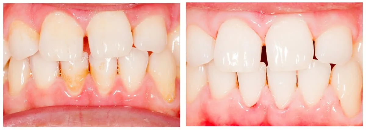 Teeth Whitening Before and After 6 - Teeth Whitening London