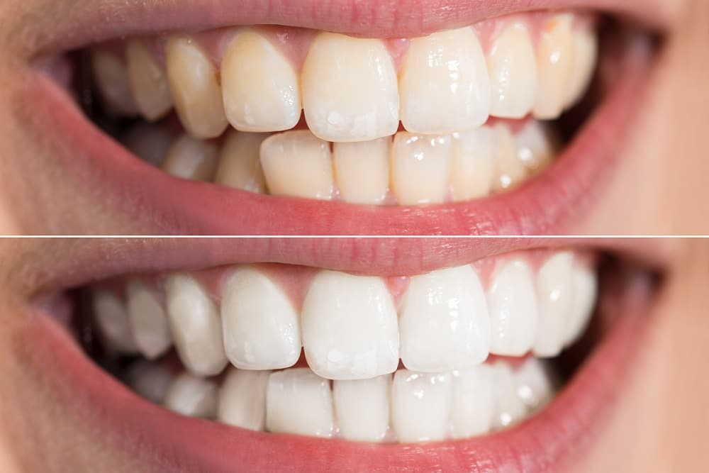 Teeth Whitening Before and After 4 - Teeth Whitening London
