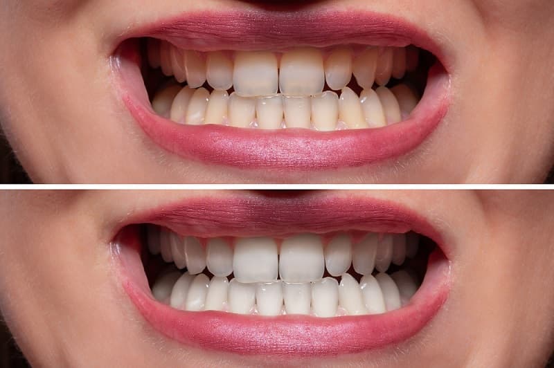 Teeth Whitening Before and After 3 - Teeth Whitening London