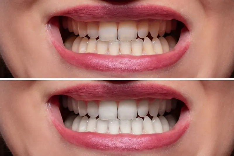 Teeth Whitening Before and After 3 - Teeth Whitening London