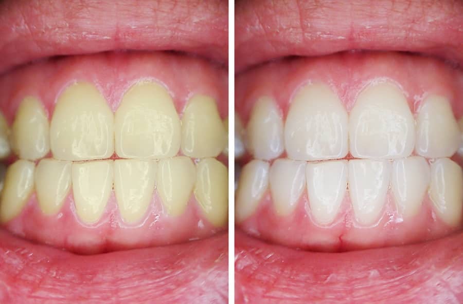 Teeth Whitening Before and After 2 - Teeth Whitening London
