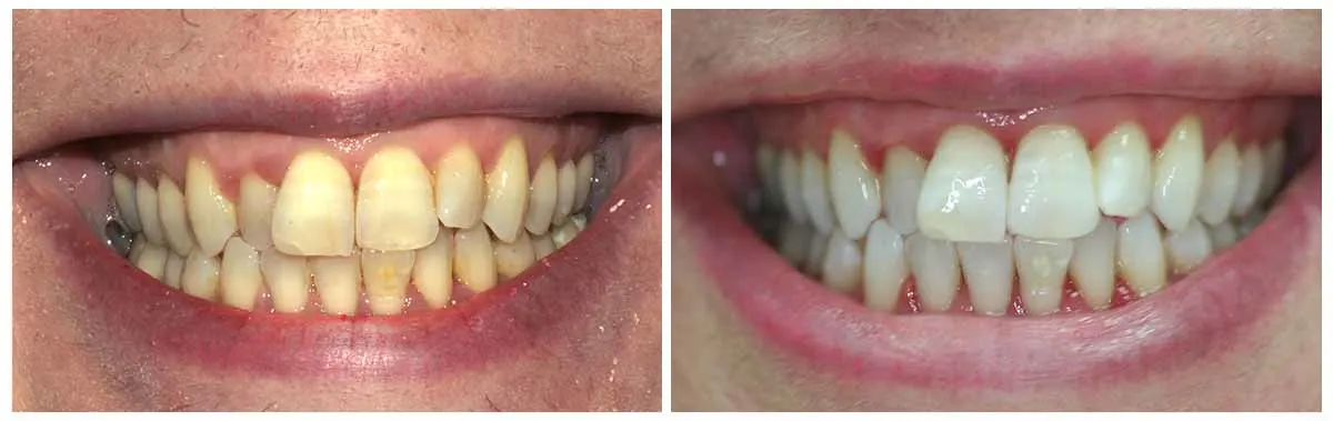 Teeth Whitening Before and After 7 - Teeth Whitening London