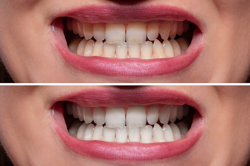 Teeth Whitening London UK's Premiere Teeth Whitening Clinic