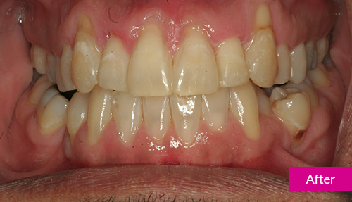 gap teeth fixed with invisalign after