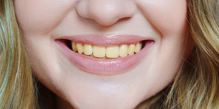 Top 10 Causes of Yellow Teeth (and How to Prevent Them)